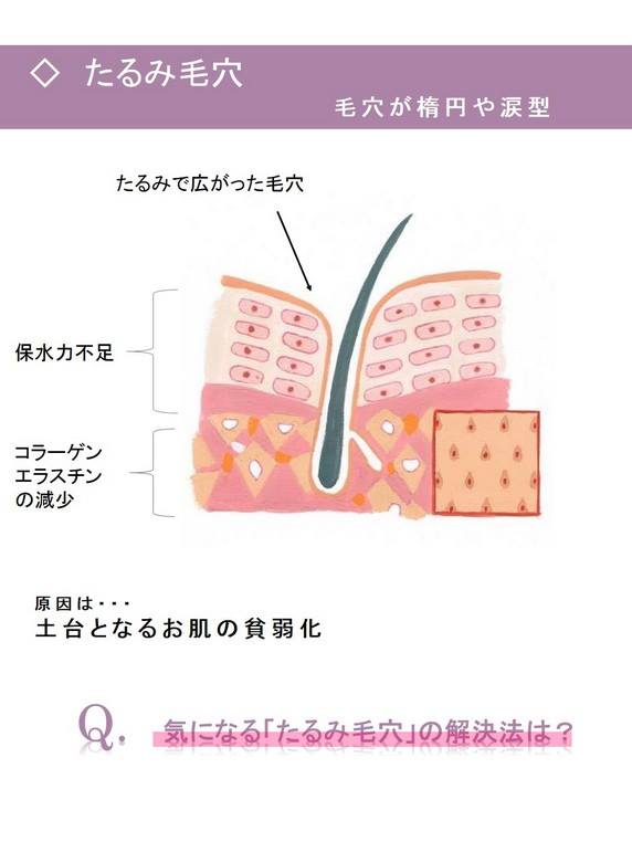 毛穴ケア２〜たるみ毛穴はしわを呼ぶ！早めのケアを