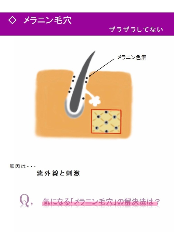 毛穴ケア５〜なかなかとれない毛穴の黒ずみ。それってメラニン毛穴かも！